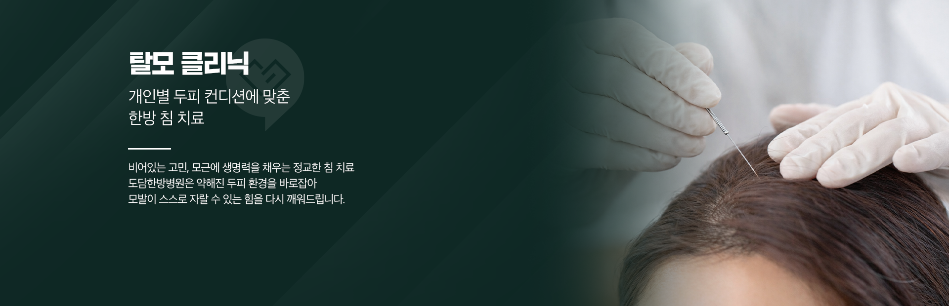 탈모 클리닉-개인별 두피 컨디션에 맞춘-한방 침 치료